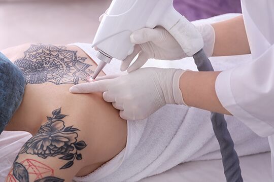 How Laser Tattoo Removal Works | Harmony MedSpa